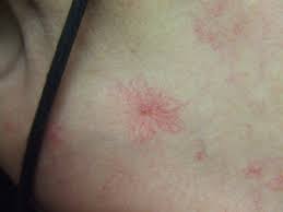 June 13 at 12:50 am · dortmund, germany ·. Hepatitis Gelbsucht Gilb Andre Seidenberg