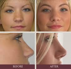 Removing my septal splints 6 days after surgery (septoplasty).a septoplasty is a surgical procedure to correct a deviated septum. Nose Job Reconstruction Surgery In Ft Lauderdale Fl Vanguard Aesthetic Plastic Surgery