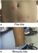 Image result for Papular urticaria