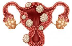 Check spelling or type a new query. Fibroid Punca Faktor Risiko Dan Cara Rawatan The Diagnosa
