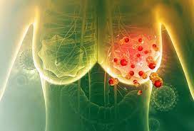 A diagnosis of metastatic breast cancer can be terrifying, whether a recurrence or an initial diagnosis. Is Breast Cancer Metastatic Terminal