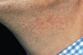 Kil Donmesi Tedavisi Dermo Ankara