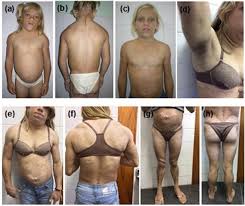 Image result for Lipodystrophy