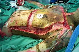 This will allow reperfusion of the limb distally or chest or abdominal expansion consider the need for escharotomy prior to transfer. Ed Doc On Twitter Escharotomy Is An Ed Emergency Procedure In Circumferential Burns As No Time For Theatre Image From Litfl Http T Co Ytrjxtde4b