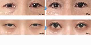 Pin On Eye Surgery