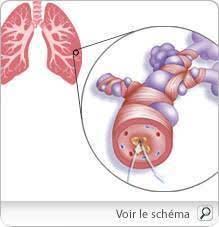 Afin de découvrir la cause, une radiographie du thorax est nécessaire…. La Toux Seche Ses Causes Et Les Solutions Pour En Venir A Bout