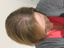 Evening primrose oil, also known as epo, is a popular supplement with numerous health claims. Hair Thinning Any Advice Today It Appears Thyroid Uk