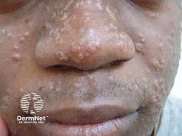 Image result for skin rash acute hiv infection