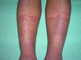 Hsp can happen at any age but is most common in children 2 to 11 years of age. Koebner S Phenomenon In Henoch Schoenlein Purpura And Role Of Pressure In Its Causation