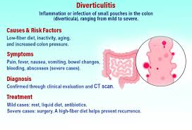 Image result for Diverticulitis