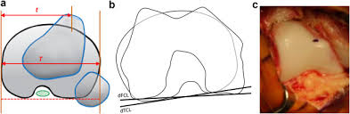 Image result for Patellar Tilt Test