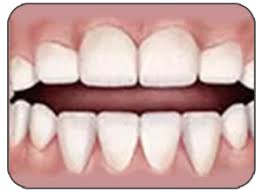 Corrective measures for pacifier teeth can cost a pretty penny, sometimes exceeding $10,000.00. Prolonged Pacifier Use Innovative Myofunctional Therapy