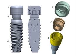 Nobel Active Implant Fixture And Locator Stud Attachment