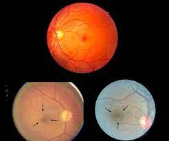 This exposure to the light can cause damage or even destroy cells in the retina (the back of the eye) that transmit what you see to the brain. A Solar Eclipse Can Blind You Read This Before Looking At The Sun Space