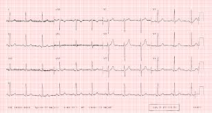 Ecglibrary Com Normal Adult 12 Lead Ecg