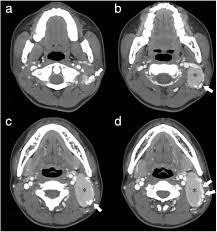 Castleman Disease Versus Lymphoma In Neck Lymph Nodes A Comparative Study Using Contrast Enhanced Ct Cancer Imaging Full Text