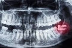 Risultati immagini per dente del giudizio