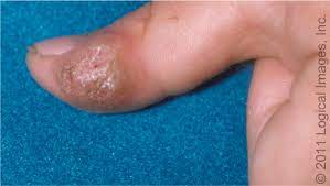 Oct 15, 2011 · heel pain is a common presenting symptom in ambulatory clinics. Treatment Of Nongenital Cutaneous Warts American Family Physician