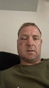 James Walshaw, former semi-professional footballer, and now football  manager for Ossett United, has shared his experience of receiving care at  Pinderfields Hospital after his first attempt at rugby left him with five