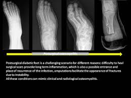 Image result for Osteomyelitis XRay