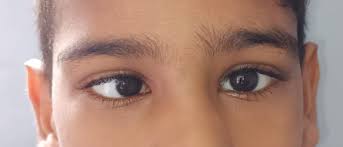 Image result for Eye Deviation