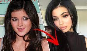 By now, everyone has heard about the scandal between kylie jenner and her best friend, jordyn woods. Kylie Jenner Plastic Surgery Before And After Express Co Uk