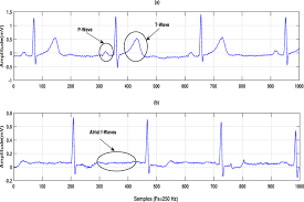 During this lecture we will begin by learning how t. Detection Of Atrial Fibrillation From Single Lead Ecg Signal Using Multirate Cosine Filter Bank And Deep Neural Network Springerlink