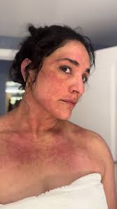 Be proud of your journey! #healingjourney #sensitivenervoussystem #eczema