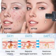 Tiworld™ PoreClear 2% Omi isọdọtun awọ ara BHA