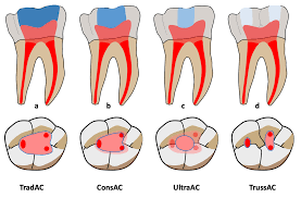 Minimally Invasive Access Cavities: A Benefit/Risk Analysis