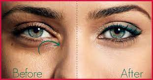To achieve direct pressure in ant epistaxis, ___ bridge of nose. How To Get Rid Of Spectacle Marks On Your Nose Naturally