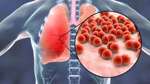 Image result for Pneumonia