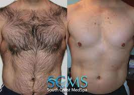 Laser hair removal procedure is useful for removing unwanted hair from the face, leg, chin, back, arm, underarm, bikini line, and other areas. Full Body Laser Hair Removal Package