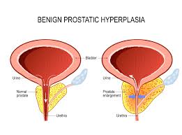 Pin On Prostate Health