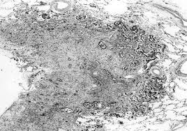 electron microscopy in the diagnosis of pleural mesotheliomas. Mesothelioma Springerlink