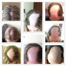 Hair at the top of the head also thins, often progressing to baldness. 12 Things People Living With Alopecia Want You To Know Hair Loss Women Hair Loss Hair Loss Treatment Shampoo