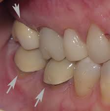 Some dentists do charge more but that is not the norm. A Comparison Of Dental Crown Materials Portland Or Dr Martha Rich Dmd A Comparison Of Dental Crown Materials Dentist Portland Or