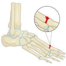 Foot injury can cause a tumor to start hurting. Turf Toe Symptoms Treatment And Recovery
