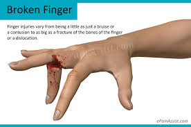 So, i decided to skip the er and go straight to the. Broken Finger Treatment Causes Symptoms Signs