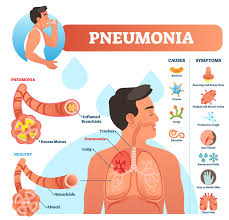Image result for Pneumonia