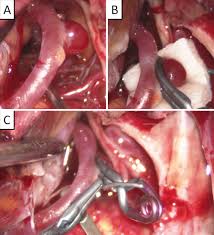 Clip Ligation For Ruptured Intracranial Aneurysm In A Child With Loeys Dietz Syndrome Case Report In Journal Of Neurosurgery Pediatrics Volume 21 Issue 4 2018 Abdominal aortic aneurysm (aaa) is a focal dilatation of the abdominal aorta to more than 1.5 times its normal diameter.