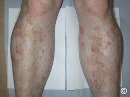 Image result for Pigment stains on the shin