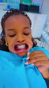 Braces Transformation by Dr. Emmanuel in Kampala, Uganda