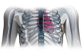 Anesthesia provider, surgeon, proceduralist or designee may place an order for icd / pacemaker procedural management and page the cvc/uh device nurse. Pacemaker And Implantable Cardioverter Defibrillator Program Children S Health Orange County
