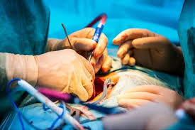 Aneurysm Repair