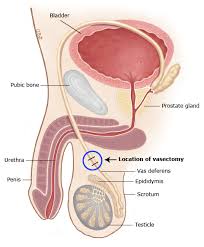 Image result for Vasectomy