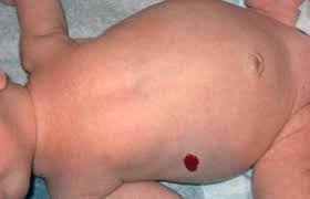 This article provides information on what symptoms are unique to each specific type of skin cancer. Birthmarks Signs And Symptoms