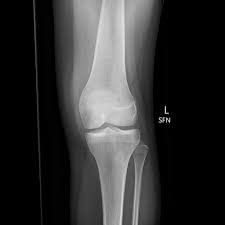 We did not find results for: Osteochondral Fracture Lateral Femoral Condyle Radiology Case Radiopaedia Org