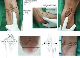 The medial epicondyle is the bony origin for the wrist flexors and involve the. 11 Some Anatomical Landmarks In The Elbow Joint O Olecranon Process Download Scientific Diagram