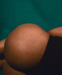 Dangers And Risk Of BBL Surgery: Plastic Surgery Abroad